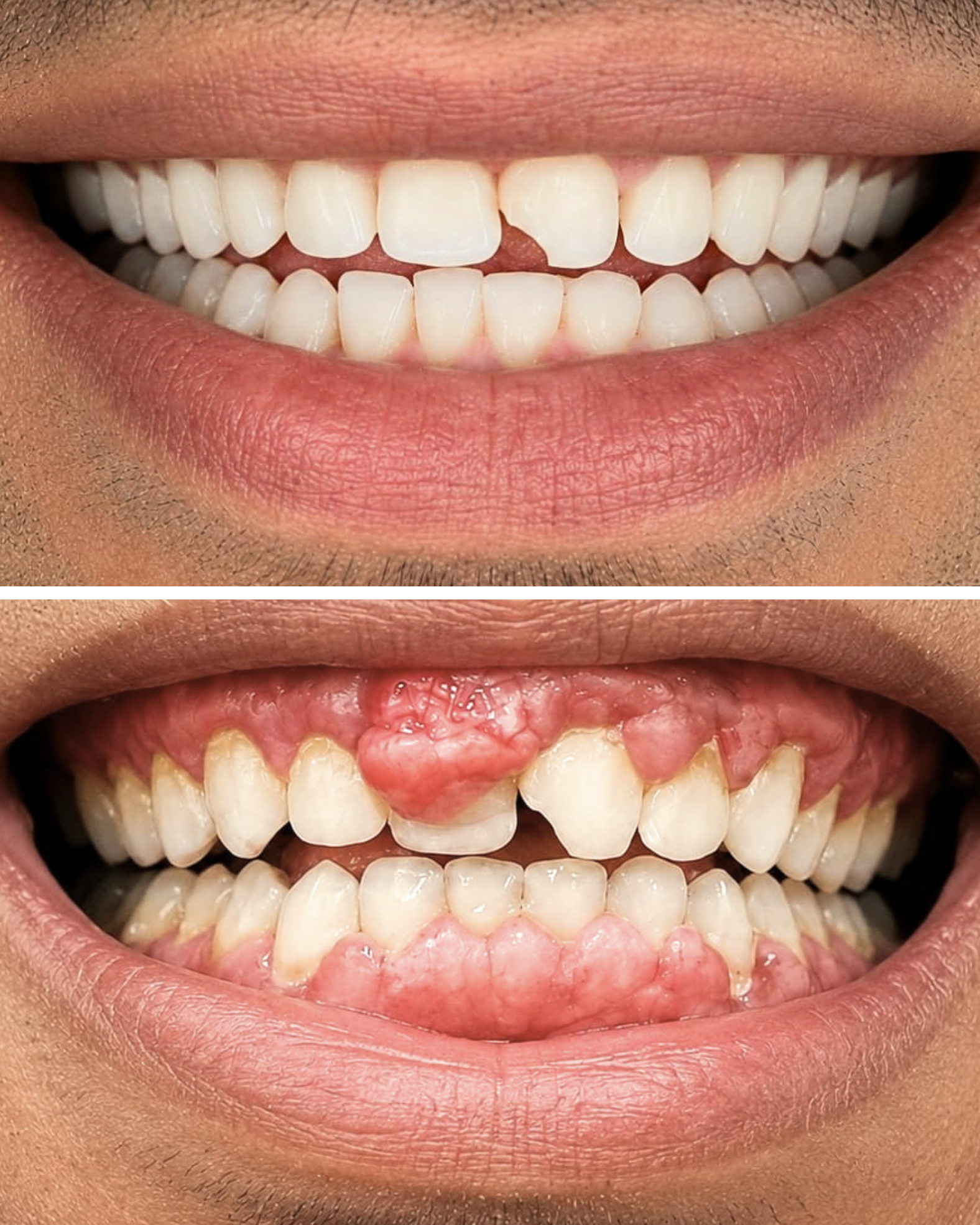 Traitement gingival